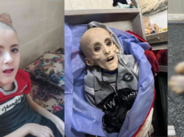 9-anyos nga may cerebral palsy nagtaliwan bangud sa kakulang sa pagkaon sa Gaza