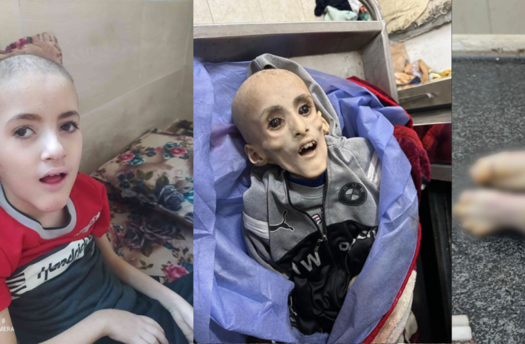 9-anyos nga may cerebral palsy nagtaliwan bangud sa kakulang sa pagkaon sa Gaza